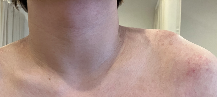 左肩の肩鎖関節脱臼の写真。顔は写っていません